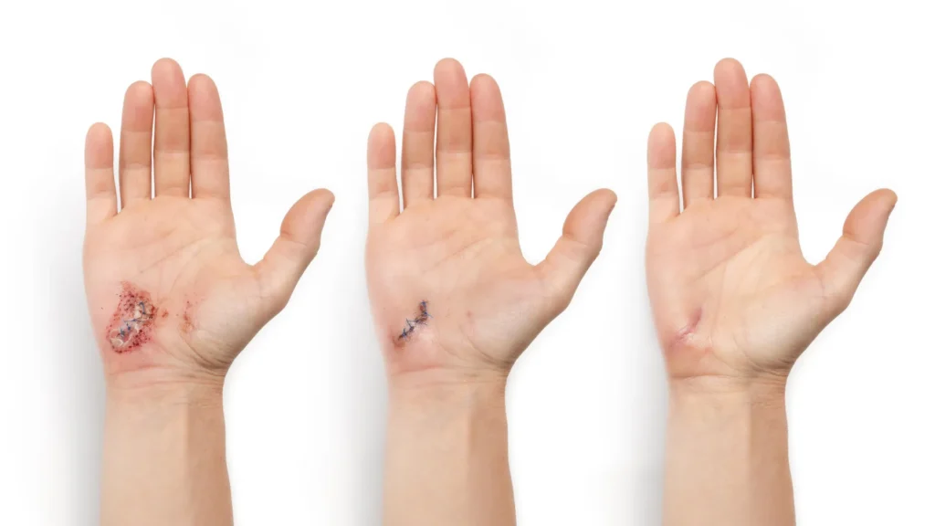 AI-powered smart bandage heals wounds 25% faster
