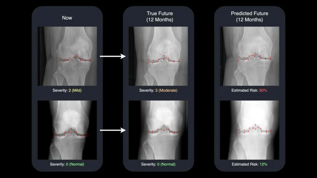 AI turns x-rays into time machines for arthritis care AI turns x-rays into time machines for arthritis care