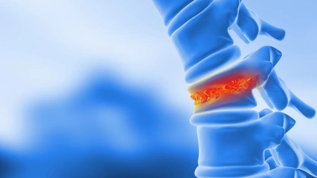 Scientists turn body fat into bone to heal spinal fractures