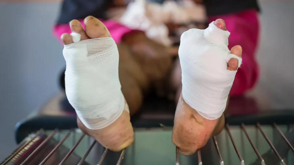 New oxygen gel could prevent amputation in diabetic wound patients New oxygen gel could prevent amputation in diabetic wound patients